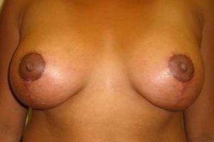 Manhattan Breast Lift after 1